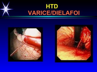 HTD     VARICE/DIELAFOI 