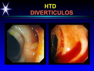 HTD     DIVERTICULOS 