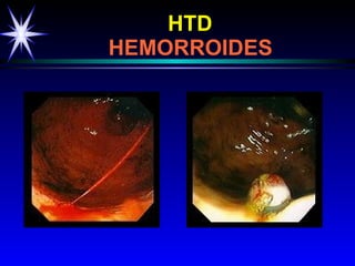 HTD     HEMORROIDES 