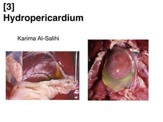 [3]
Hydropericardium
Karima Al-Salihi
 