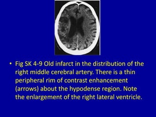 Hyperdecent 4 hypodense supratentorial masses on computed tomography | PPTX