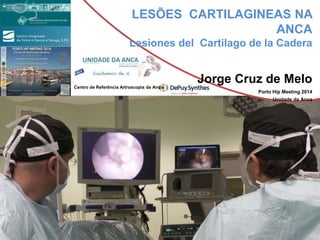 LESÕES CARTILAGINEAS NA
ANCA
Lesiones del Cartilago de la Cadera
Jorge Cruz de Melo
Porto Hip Meeting 2014
Unidade da Anca
Centro de Referência Artroscopia da Anca
 