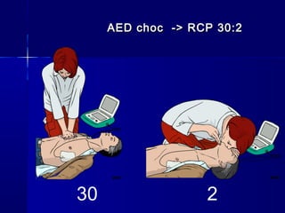 AED choc -> RCP 30:2AED choc -> RCP 30:2
30 2
 