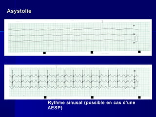 AsystolAsystolieie
Rythme sinusal (possible en cas d’une
AESP)
 