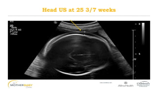 Head US at 25 3/7 weeks
 