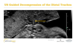 US Guided Decompression of the Distal Trachea
 