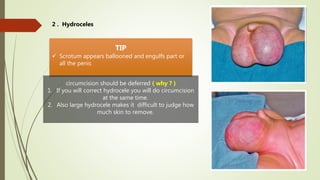 pediatric genitalia1 Pediatric Circumcision lecture | PPT