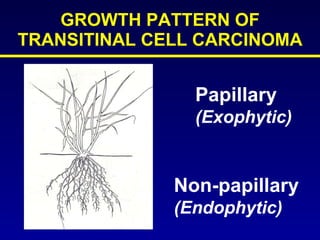 GROWTH PATTERN OF TRANSITINAL CELL CARCINOMA Papillary  (Exophytic) Non-papillary (Endophytic) 