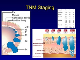 TNM Staging 
