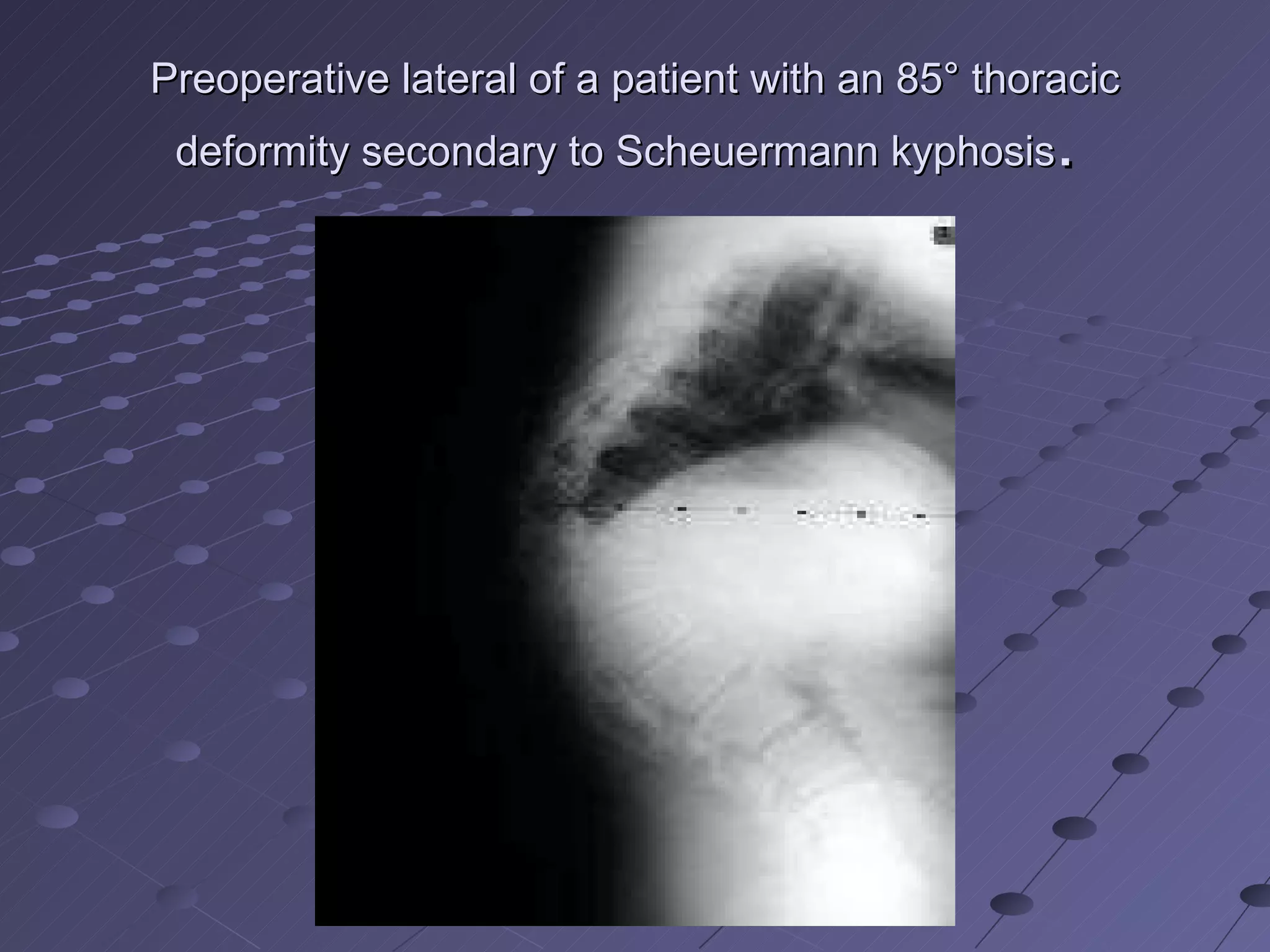 Preoperative lateral of a patient with an 85° thoracic deformity secondary to Scheuermann kyphosis .  