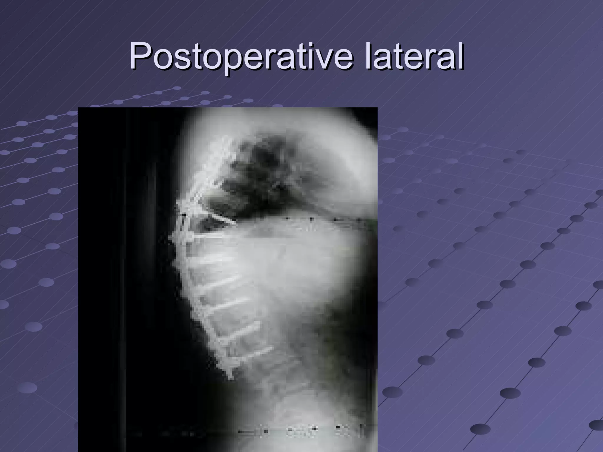 Postoperative lateral  