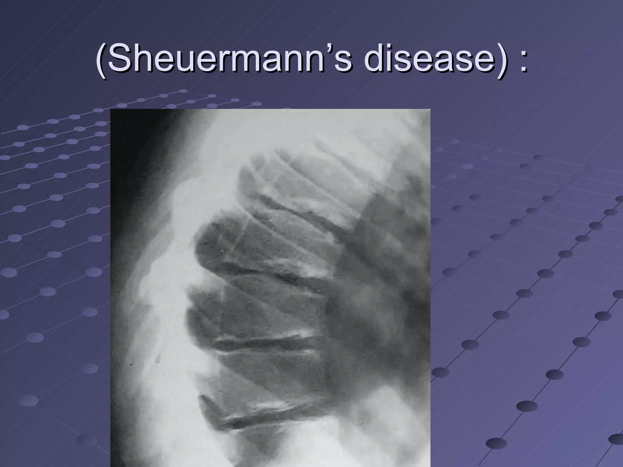 (Sheuermann’s disease) : 