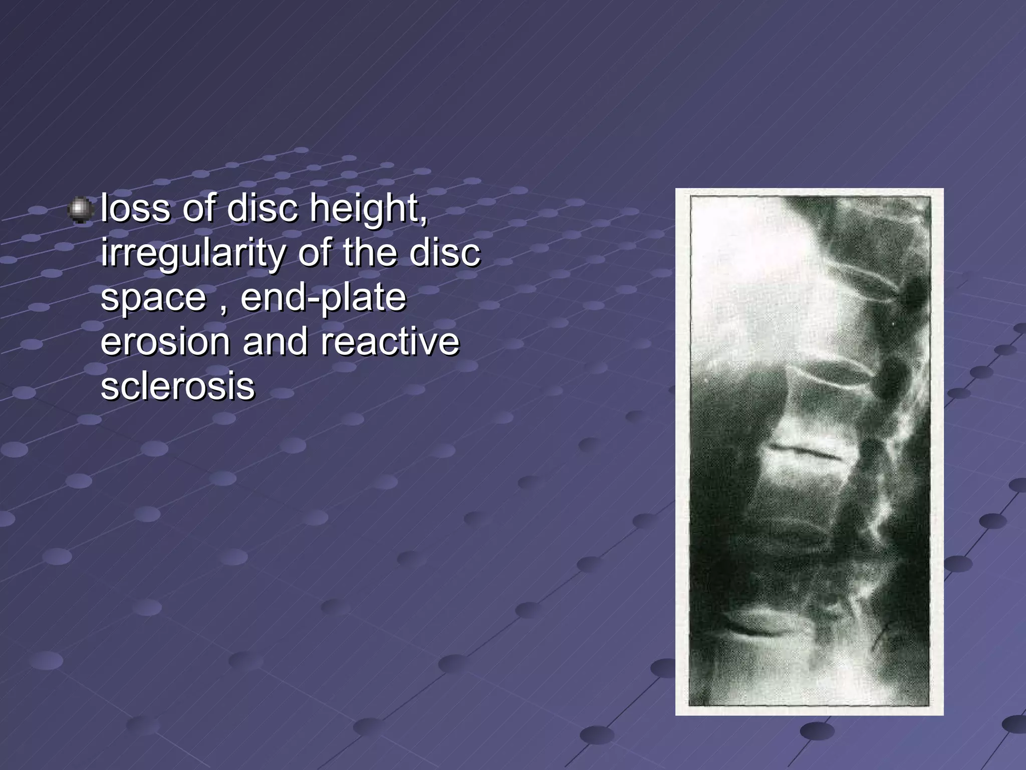 loss of disc height, irregularity of the disc space , end-plate erosion and reactive sclerosis 