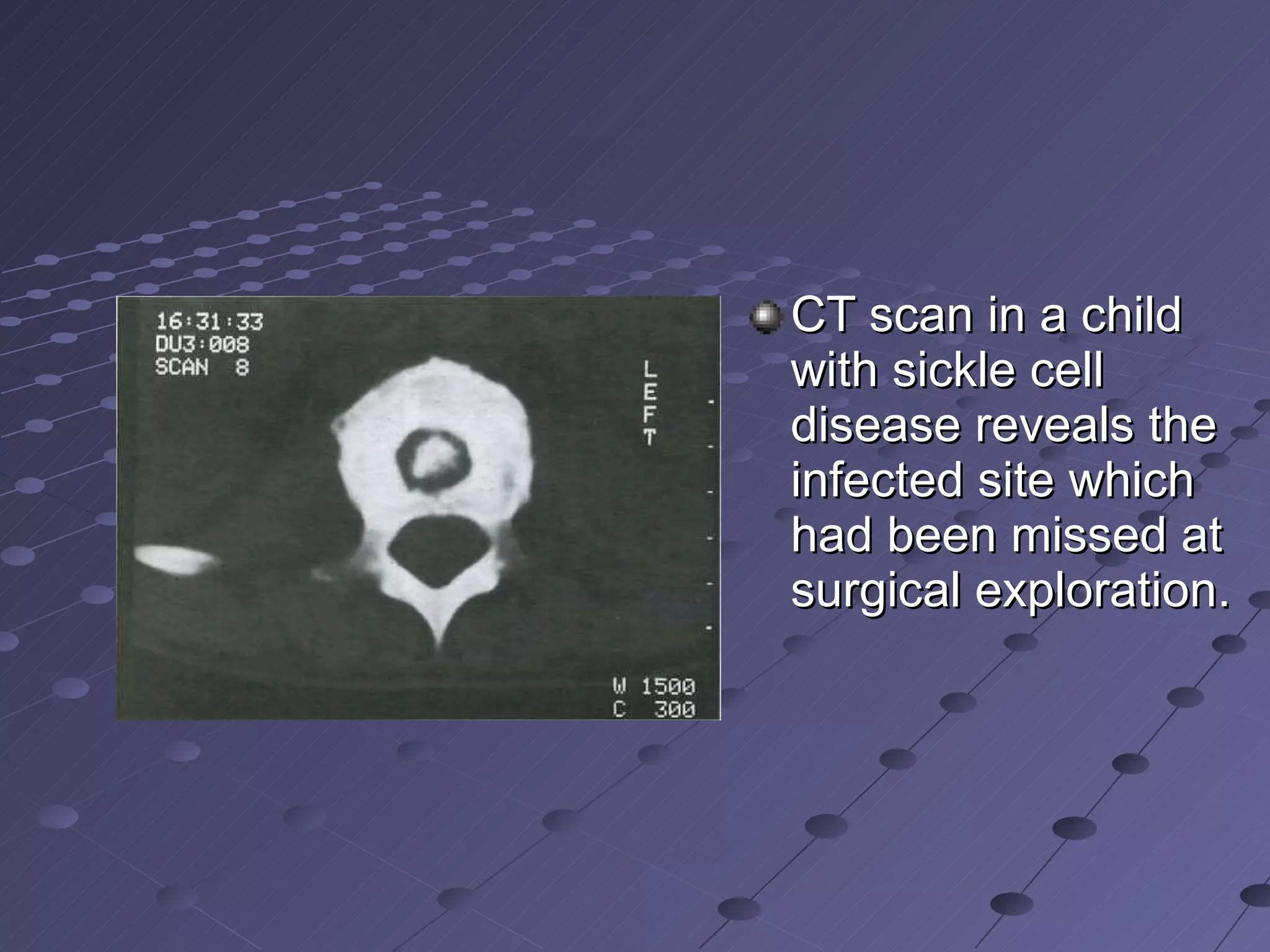 CT scan in a child with sickle cell disease reveals the infected site which had been missed at surgical exploration. 
