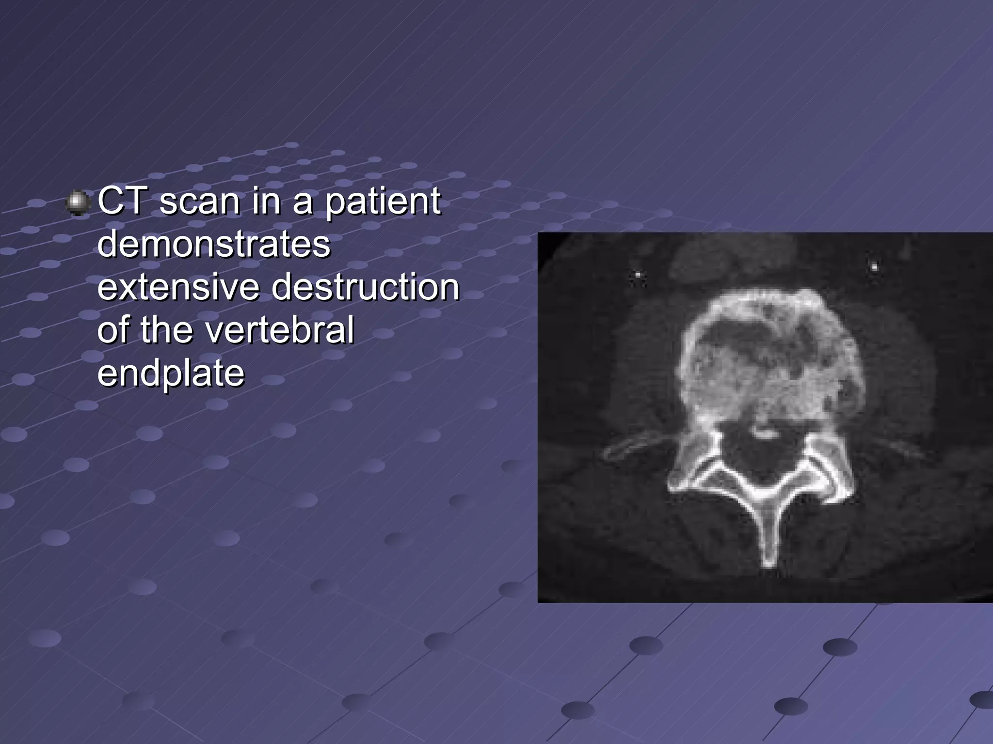 CT scan in a patient demonstrates extensive destruction of the vertebral endplate  