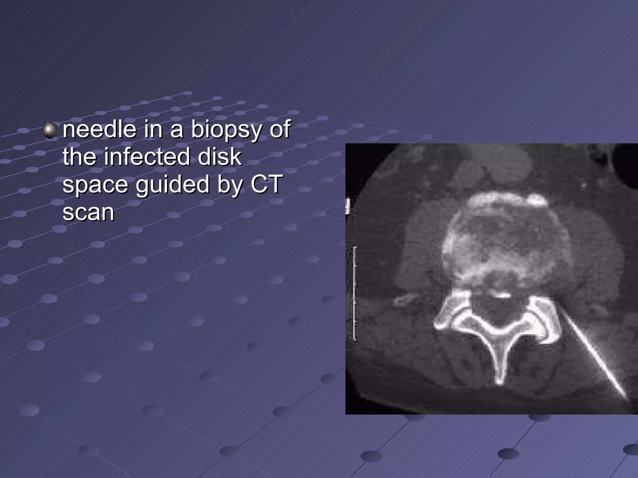 needle in a biopsy of the infected disk space guided by CT scan  