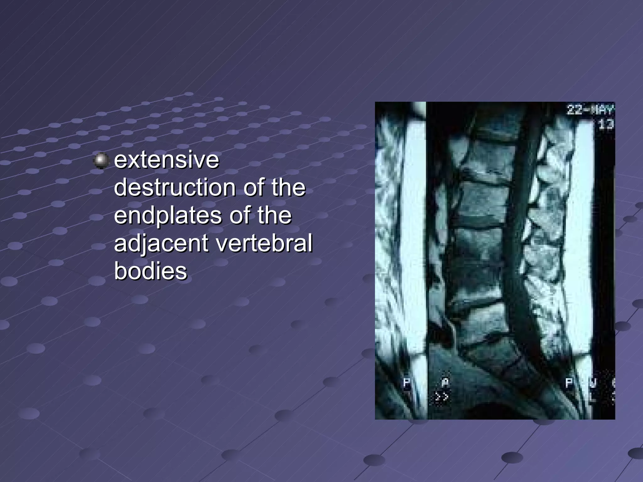 extensive destruction of the endplates of the adjacent vertebral bodies  