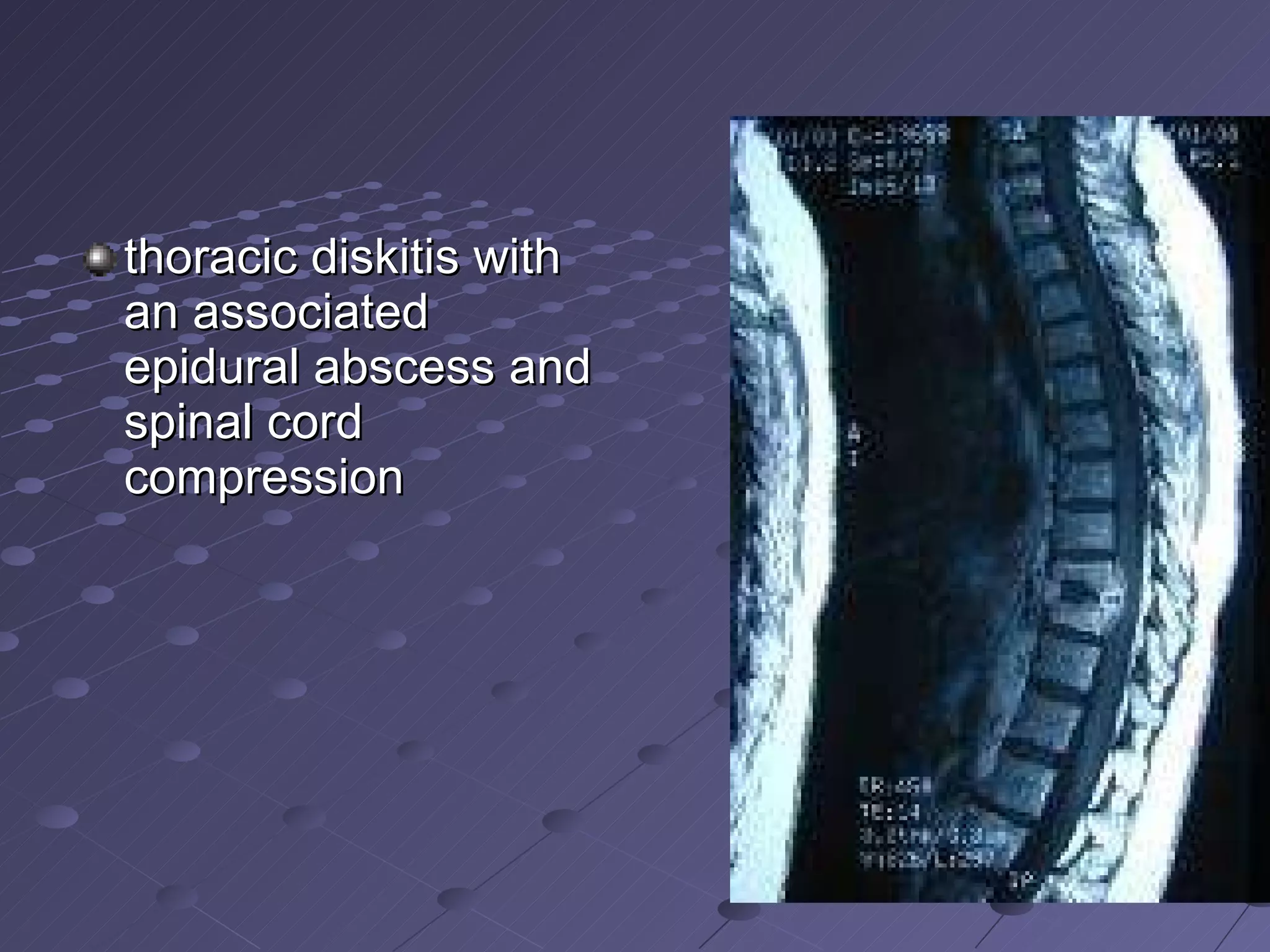 thoracic diskitis with an associated epidural abscess and spinal cord compression  