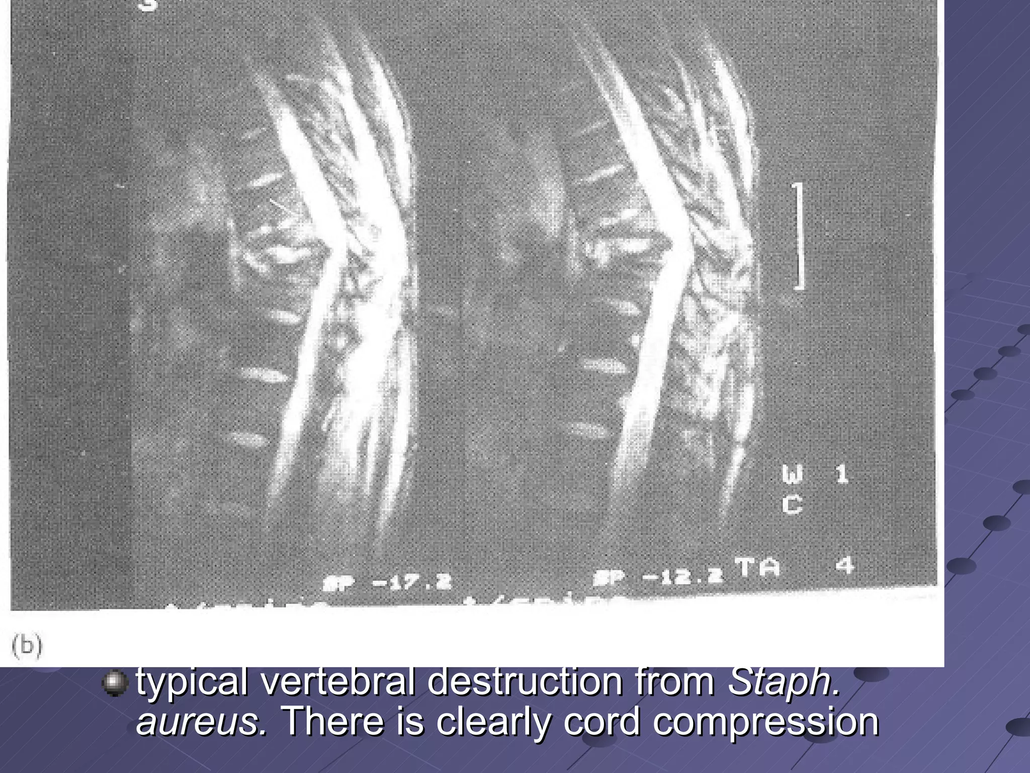 typical vertebral destruction from  Staph. aureus.  There is clearly cord compression  