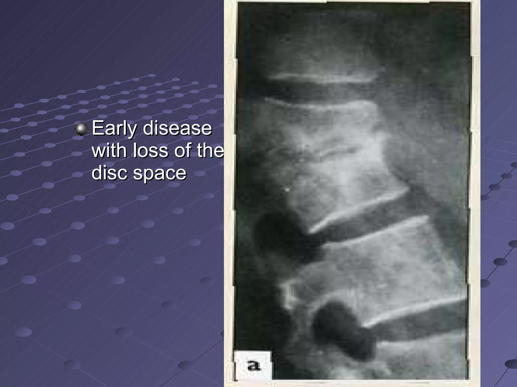 Early disease with loss of the disc space  