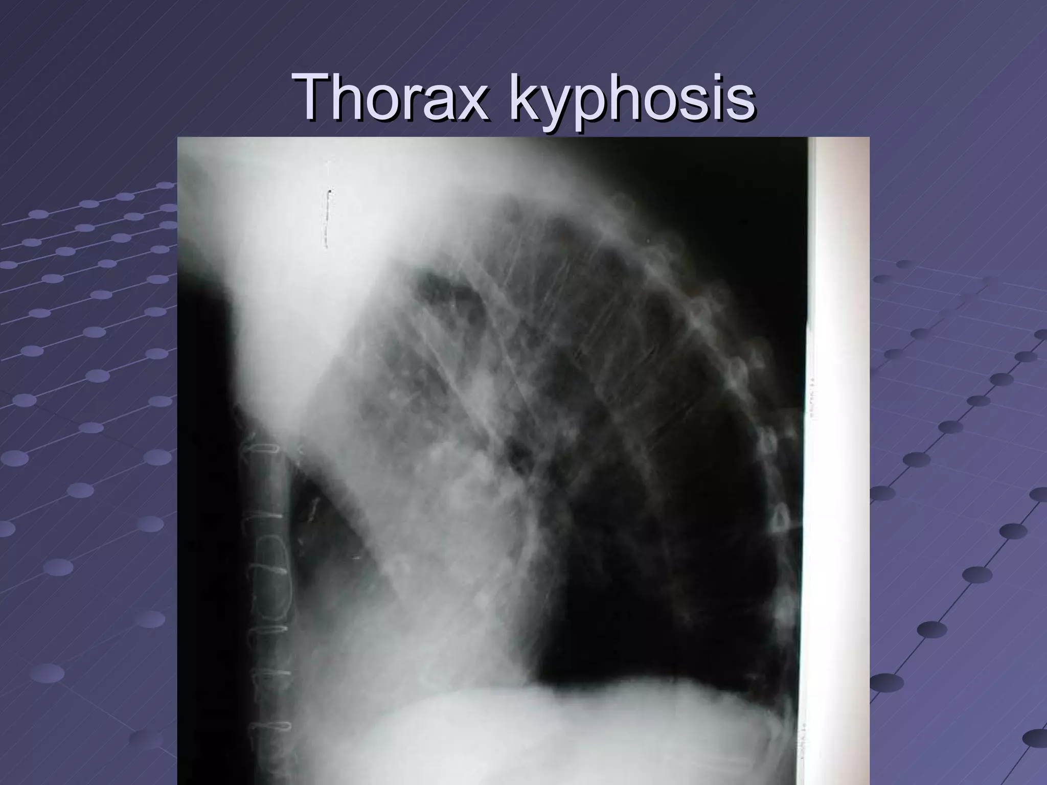 Thorax kyphosis 