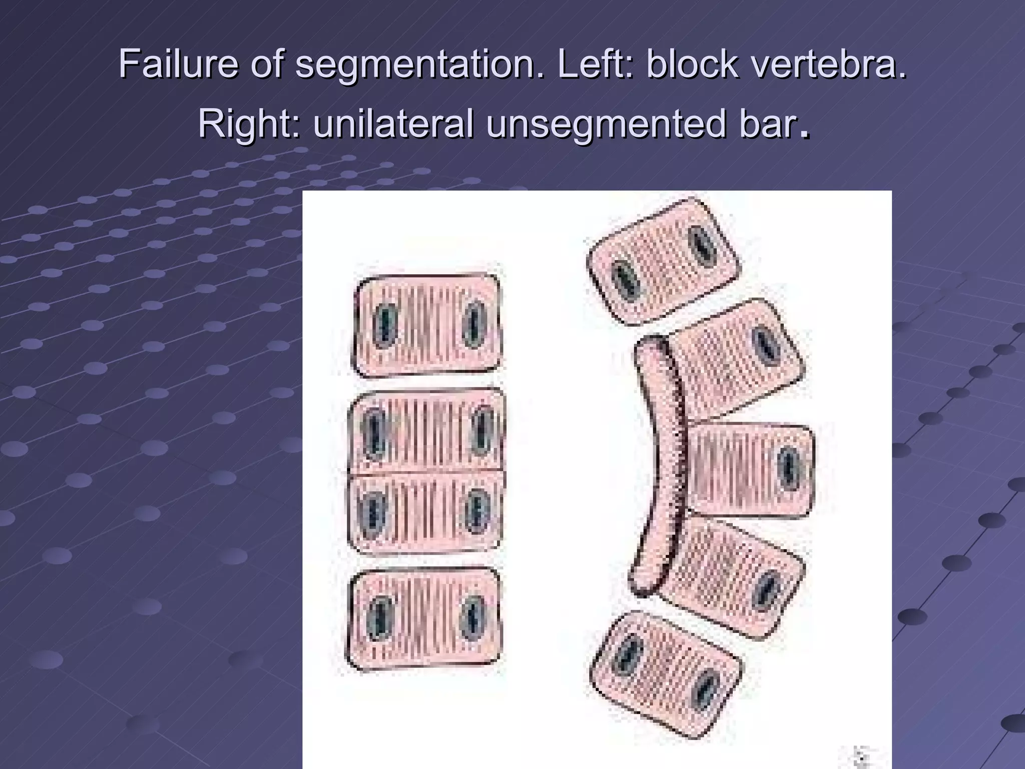 Failure of segmentation. Left: block vertebra. Right: unilateral unsegmented bar .  