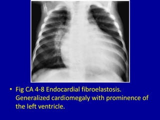4 left ventricular enlargement | PPTX