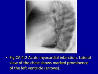 4 left ventricular enlargement | PPTX