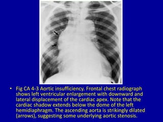 4 left ventricular enlargement | PPTX