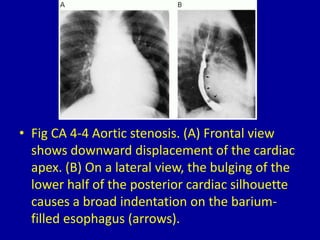 4 left ventricular enlargement | PPTX