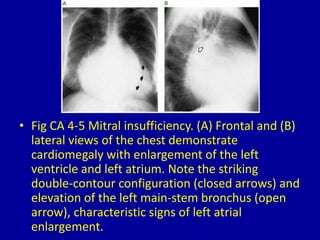 4 left ventricular enlargement | PPTX
