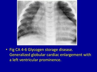 4 left ventricular enlargement | PPTX