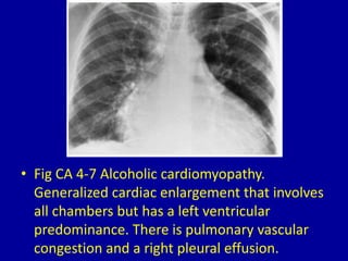 4 left ventricular enlargement | PPTX