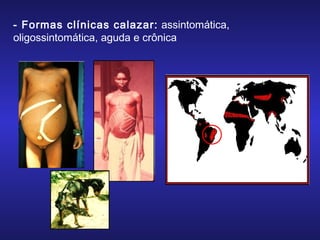 - Formas clínicas calazar: assintomática,
oligossintomática, aguda e crônica

 