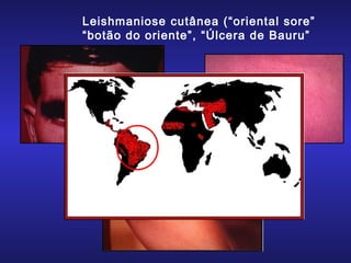 Leishmaniose cutânea (“oriental sore”
“botão do oriente”, “Úlcera de Bauru”

 