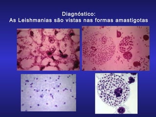 Diagnóstico:
As Leishmanias são vistas nas formas amastigotas

 