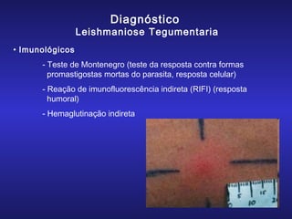 Diagnóstico

Leishmaniose Tegumentaria
• Imunológicos
- Teste de Montenegro (teste da resposta contra formas
promastigostas mortas do parasita, resposta celular)
- Reação de imunofluorescência indireta (RIFI) (resposta
humoral)
- Hemaglutinação indireta

 