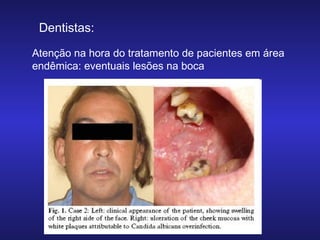 Dentistas:
Atenção na hora do tratamento de pacientes em área
endêmica: eventuais lesões na boca

 