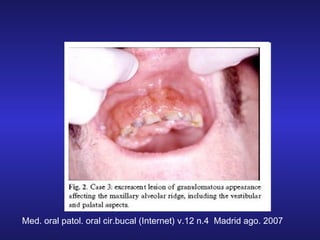 Med. oral patol. oral cir.bucal (Internet) v.12 n.4  Madrid ago. 2007

 