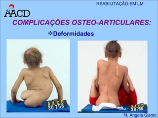 COMPLICAÇÕES OSTEO-ARTICULARES: Deformidades 