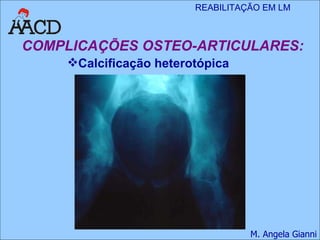 COMPLICAÇÕES OSTEO-ARTICULARES: Calcificação heterotópica 