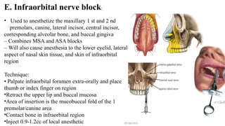 local anaesthesia used in dentistery ppt | PPTX