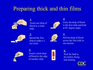 Preparing thick and thin films
1.
Touch one drop of
blood to a clean
slide.
2.
Spread the first
drop to make a 1
cm circle.
3.
Touch a fresh drop
of blood to the edge
of another slide.
6.
Wait for both to
dry before fixing
and staining.
5.
Pull the drop of blood
across the first slide in
one motion.
4.
Carry the drop of blood
to the first slide and hold
at 45degree angle.
 