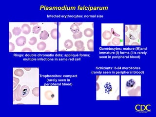 Plasmodium falciparum
Rings: double chromatin dots; appliqué forms;
multiple infections in same red cell
Gametocytes: mature (M)and
immature (I) forms (I is rarely
seen in peripheral blood)
Trophozoites: compact
(rarely seen in
peripheral blood)
Schizonts: 8-24 merozoites
(rarely seen in peripheral blood)
Infected erythrocytes: normal size
M I
 