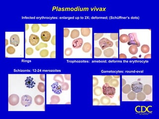 Plasmodium vivax
Trophozoites: ameboid; deforms the erythrocyte
Gametocytes: round-oval
Schizonts: 12-24 merozoites
Rings
Infected erythrocytes: enlarged up to 2X; deformed; (Schüffner’s dots)
 