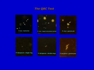 The QBC Test
The QBC Test
 