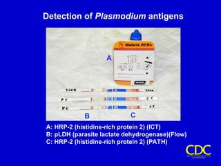 Detection of Plasmodium antigens
A: HRP-2 (histidine-rich protein 2) (ICT)
B: pLDH (parasite lactate dehydrogenase)(Flow)
C: HRP-2 (histidine-rich protein 2) (PATH)
 