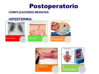 ATELECTASIA INFECCIÓN
R.
TRANSFUSIONAL
FLEBITIS Y
TF
E.
PULMONAR
COMPLICACIONES MEDIATAS
HIPERTERMIA:
Postoperatorio
 