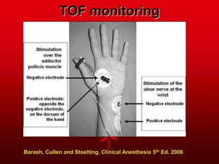 TOF monitoring
Barash, Cullen and Stoelting, Clinical Anesthesia 5th Ed. 2006
 