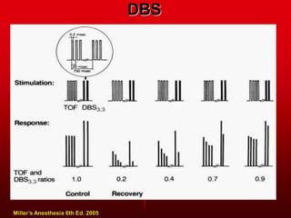 DBS
Miller’s Anesthesia 6th Ed. 2005
 